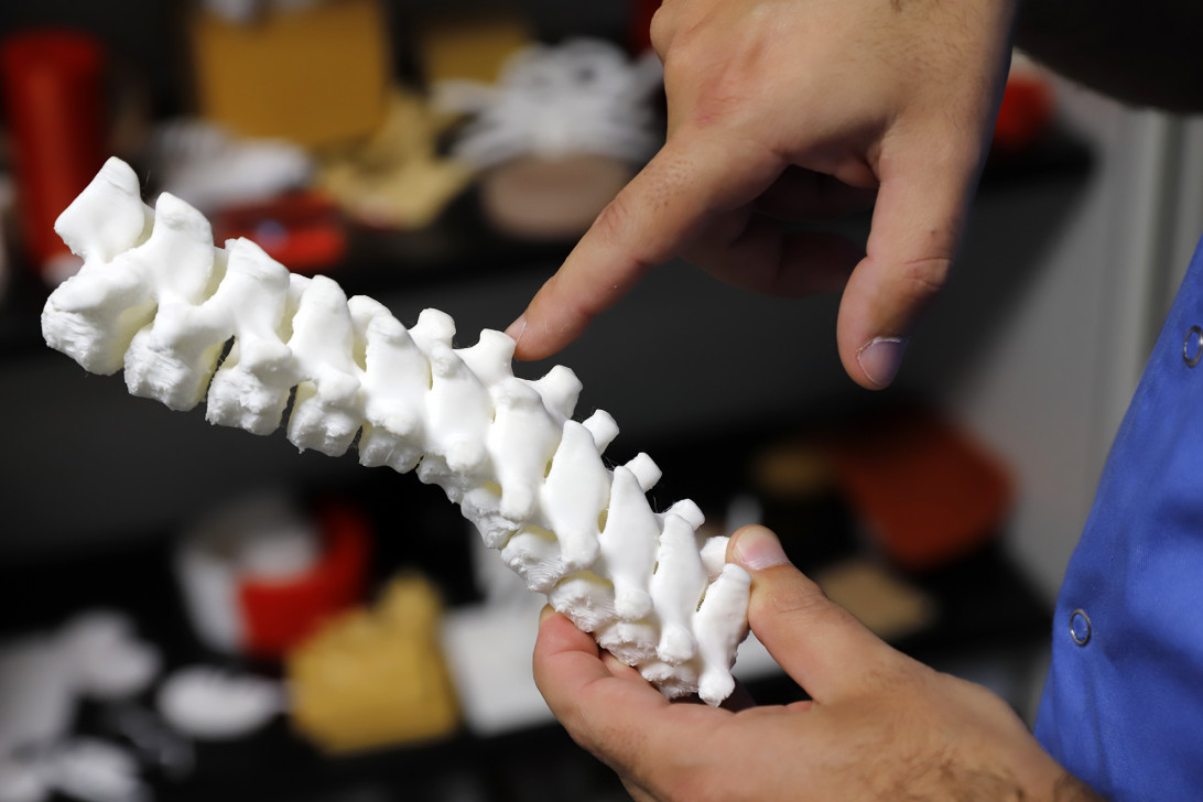 Esta imagen ilustra que: Son Espases utiliza la impresión 3D pera planificar intervenciones quirúrgicas