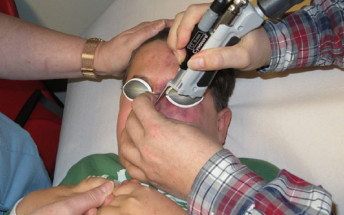 El Servicio de Dermatología adquiere el láser decolorante para eliminar las manchas rojas de la cara que servirá para evitar el desplazamiento de los pacientes a la península