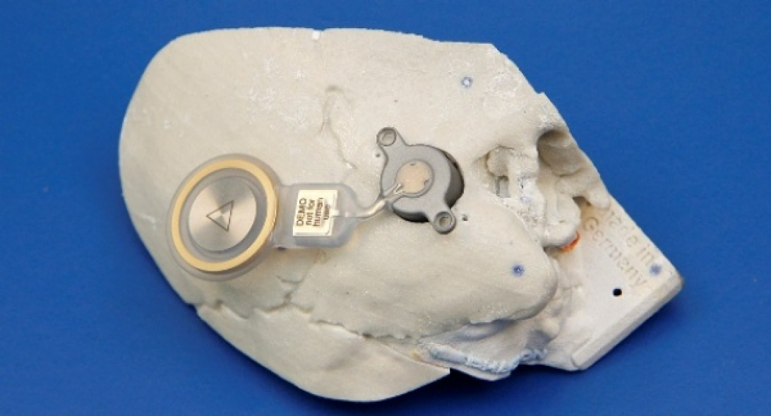 Esta imagen ilustra que: Son Espases es el tercer centro en el ámbito nacional que realiza el implante activo de conducción ósea