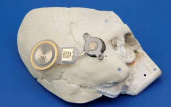 Son Espases es el tercer centro en el ámbito nacional que realiza el implante activo de conducción ósea