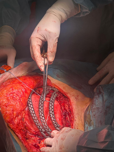 Esta imagen ilustra que: Son Espases s’afegeix a la cirurgia a mida amb una reconstrucció pionera amb costelles de titani impreses  en 3D
