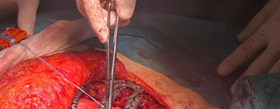 Son Espases s’afegeix a la cirurgia a mida amb una reconstrucció pionera amb costelles de titani impreses  en 3D